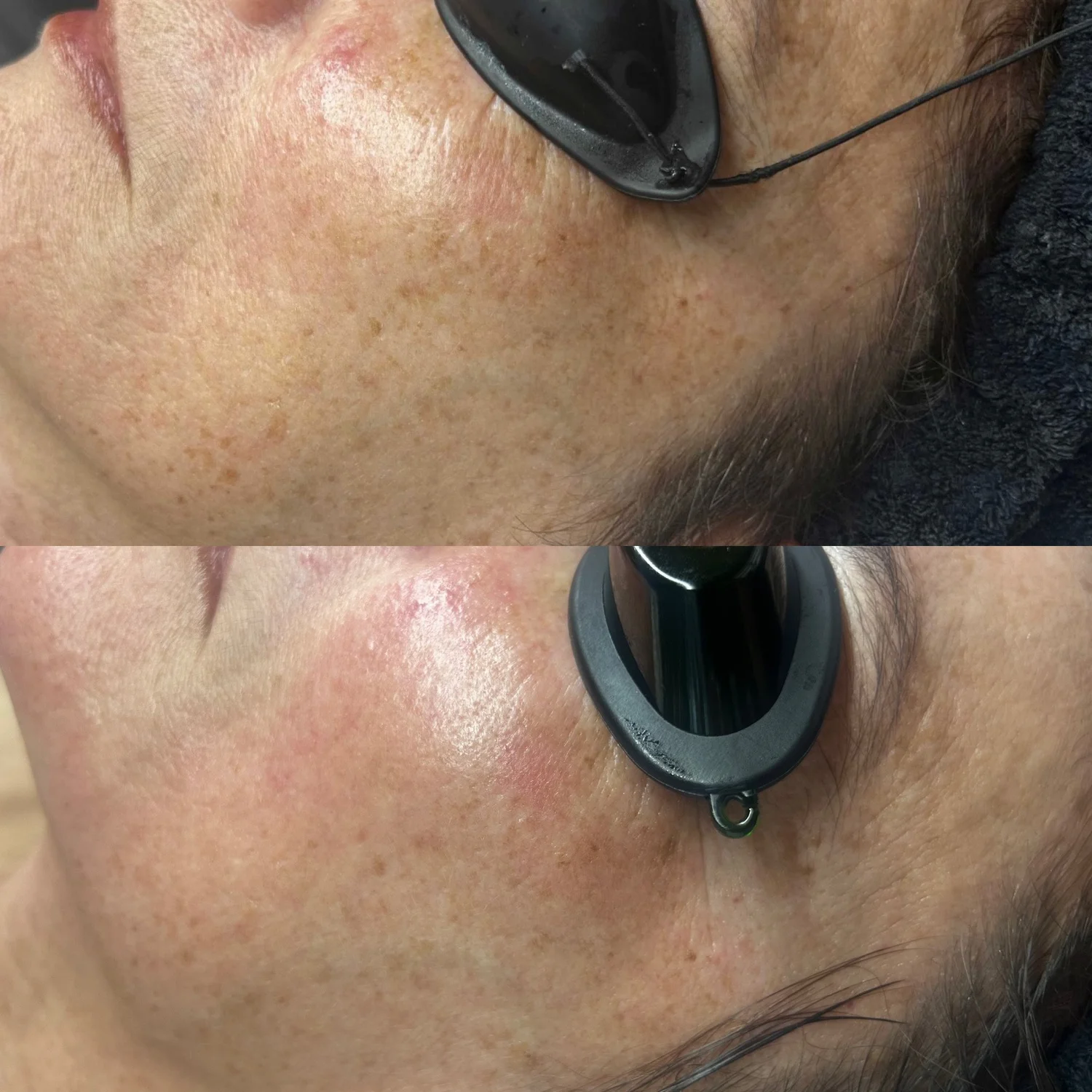 Do YOU need an Advanced Peel? at TEMPLE, Savannah