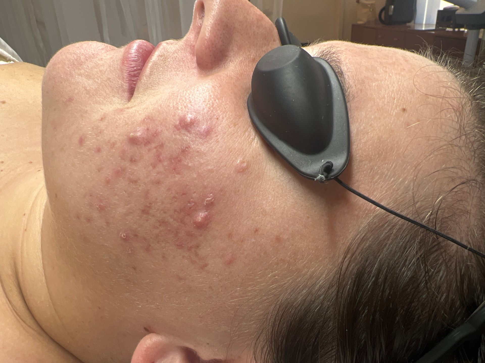 Before: Joanna’s skin journey at TEMPLE in Savannah
