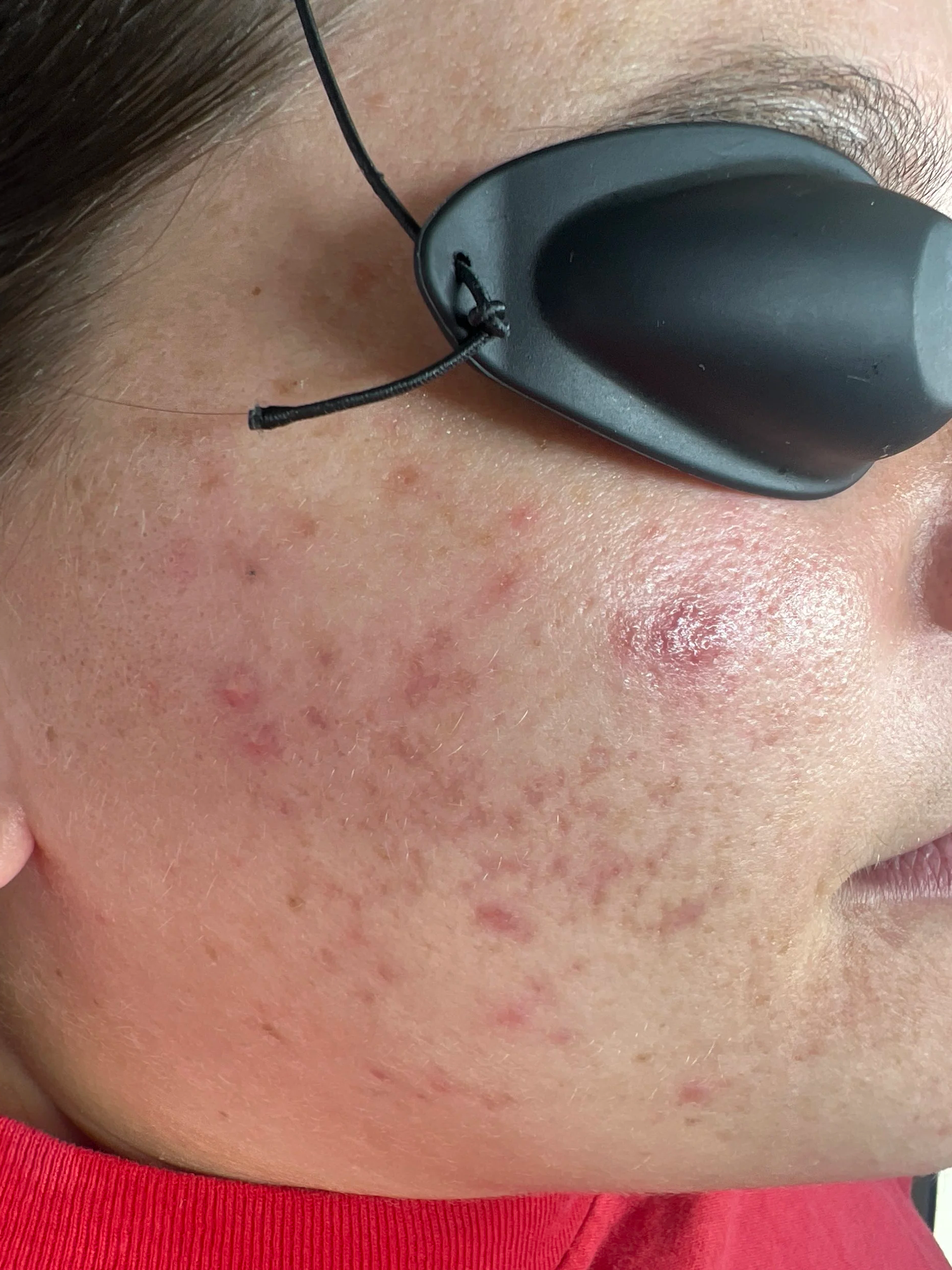 The Purge Phase | When Skin Gets Worse Before It Gets Better at TEMPLE, Savannah